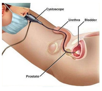 longidase a prosztatitis kezelésében prostatitis a súlyosbodás szakaszában