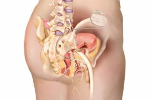 neuromodulatie-ook-bij-blaas-en-stoelgangproblemen.jpg